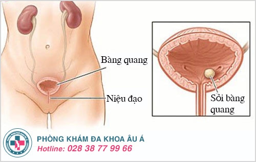 bệnh bàng quang