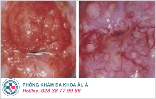 Cổ tử cung tổn thương, dấu hiệu nhiều bệnh nguy hiểm