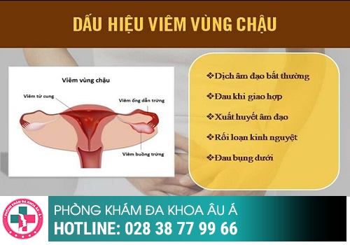 Viêm vùng chậu