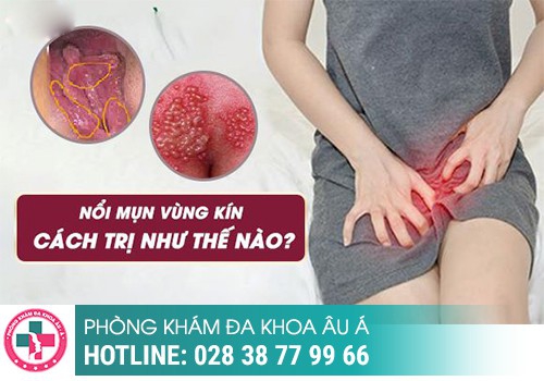 Mọc mụn ở âm đạo điều trị như thế nào?