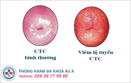 Những thông tin về đốt viêm lộ tuyến cổ tử cung