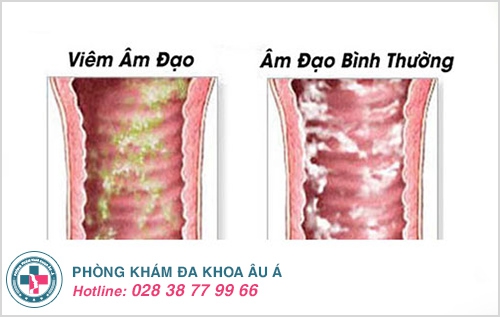 Hiện tượng hôi âm đạo ở nữ giới là dấu hiệu của bệnh gì?