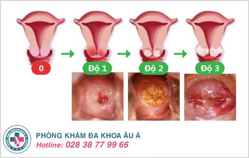 Viêm lộ tuyến cổ tử cung: không chữa sớm, dễ vô sinh