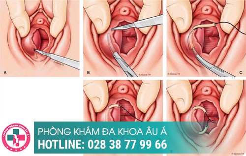 1 bên mép vùng kín bị sưng, viêm tuyến bartholin