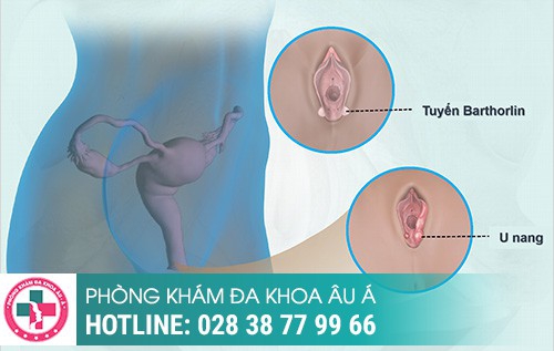 1 bên mép vùng kín bị sưng, viêm tuyến bartholin