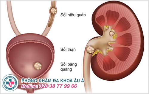 cách trị tiểu buốt, tiểu khó, tiểu nhiều lần trong ngày