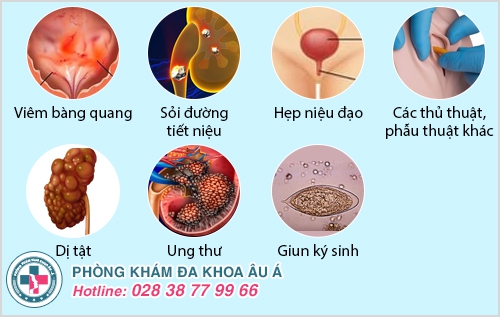 Tiểu buốt ra máu ở nữ