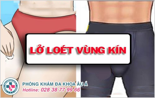 lở loét vùng kín