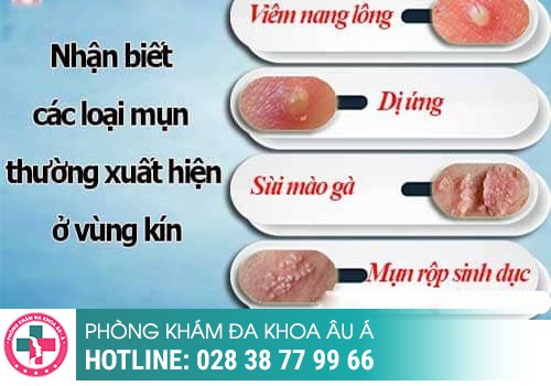 Nguyên nhân mọc mụn ở âm đạo