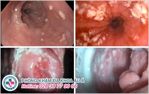 Nấm candida