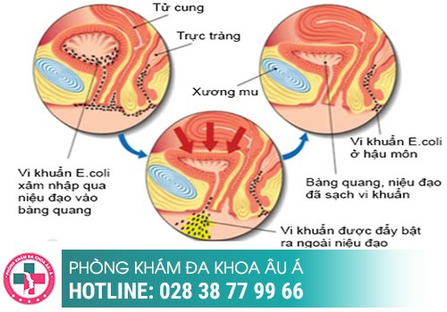 Nguyên nhân nhiễm trùng đường tiết niệu ở nữ là gì?