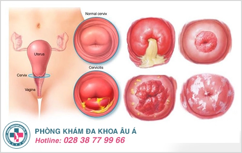 Nguyên nhân khiến huyết trắng ra nhiều