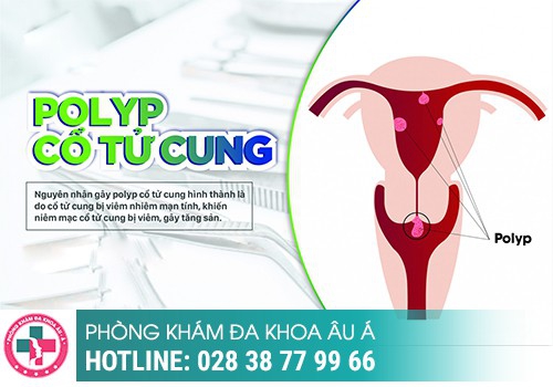 Nguyên nhân gây bệnh polyp cổ tử cung là gì?