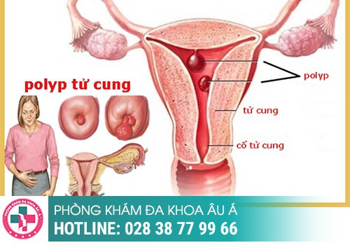 Polyp cổ tử cung là bệnh gì?Polyp cổ tử cung là bệnh gì?