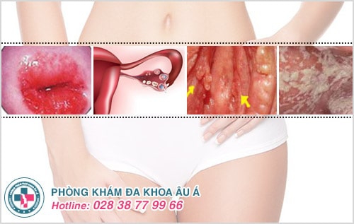 Quan hệ bị ngứa, tưởng nhẹ mà không hề nhẹ