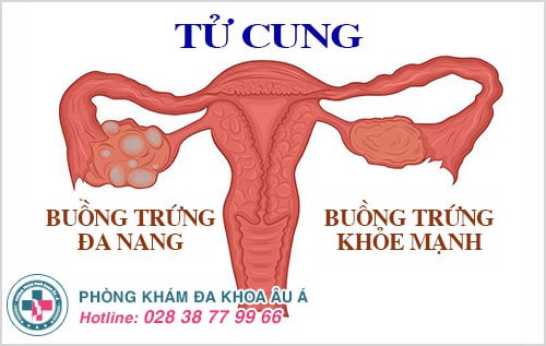 Rối loạn kinh nguyệt