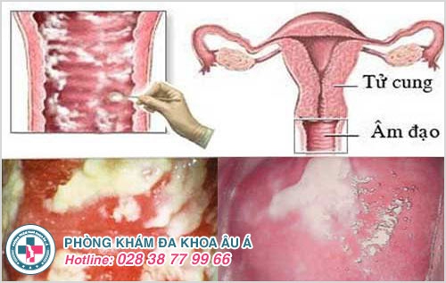 Chị em bị sưng vùng kín là dấu hiệu của bệnh gì?