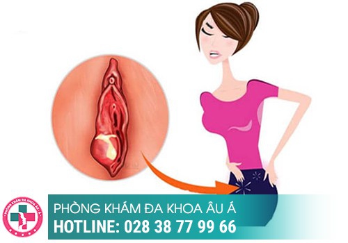 Vùng kín bị sưng 1 bên mép là bệnh gì?