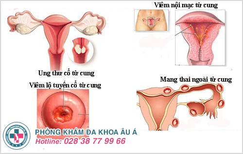 Tại sao khí hư có màu đen?