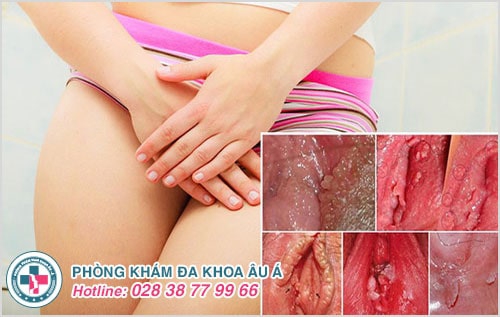 Nỗi lo khi xuất hiện thịt dư âm đạo