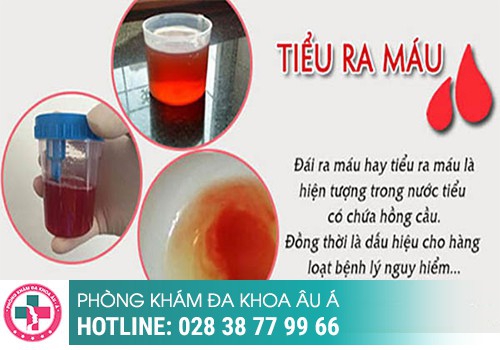 NGUYÊN NHÂN GÂY TIỂU RA MÁU