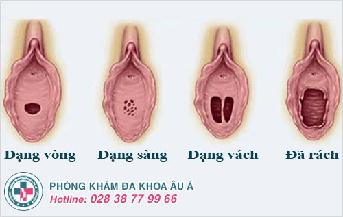 vá màng trinh