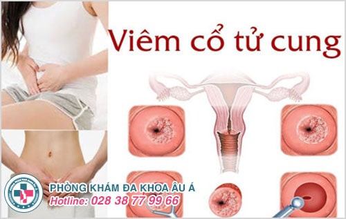 Viêm cổ tử cung: bệnh nguy hiểm có thể gây vô sinh ở nữ giới