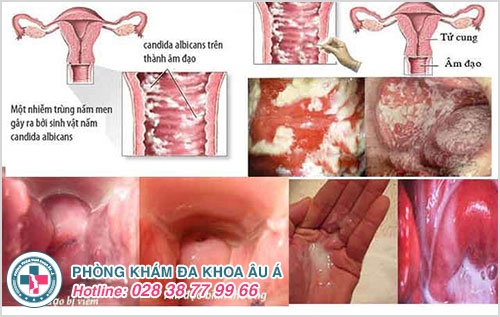 xước vùng kín
