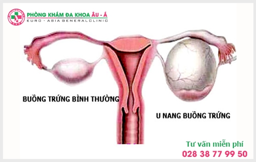 Biến chứng nguy hiểm của u nang buồng trứng