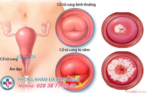 Nguyên nhân - dấu hiệu viêm lộ tuyến cổ tử cung