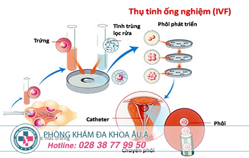 Nguyên nhân vô sinh ở nữ