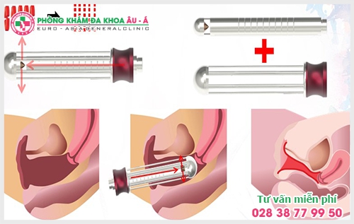 Thủ thuật thu nhỏ âm đạo - chan đầy hạnh phúc lứa đôi