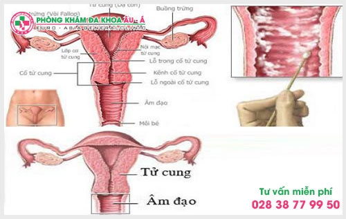 TRIỆU CHỨNG, BIỂU HIỆN CỦA VIÊM NẤM ÂM ĐẠO